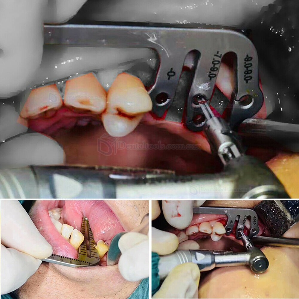 TT Localizador quir&uacute;rgico L y S para implantes con regla de medici&oacute;n